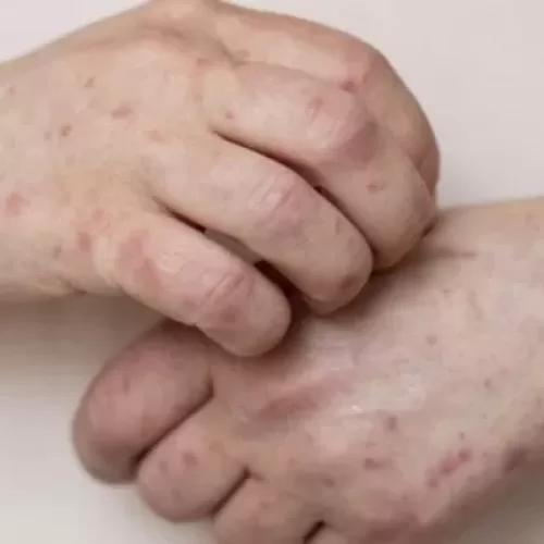 Bahia investiga novo caso suspeito de Mpox